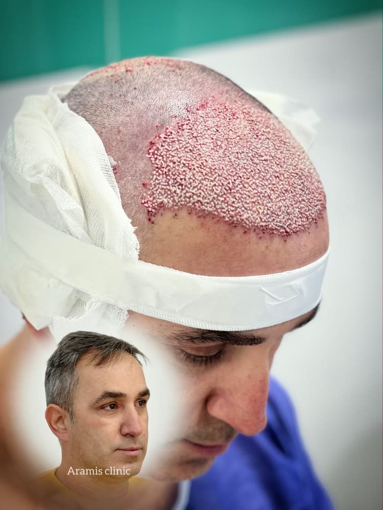 تصویر 1 - نمونه کار کاشت مو 1