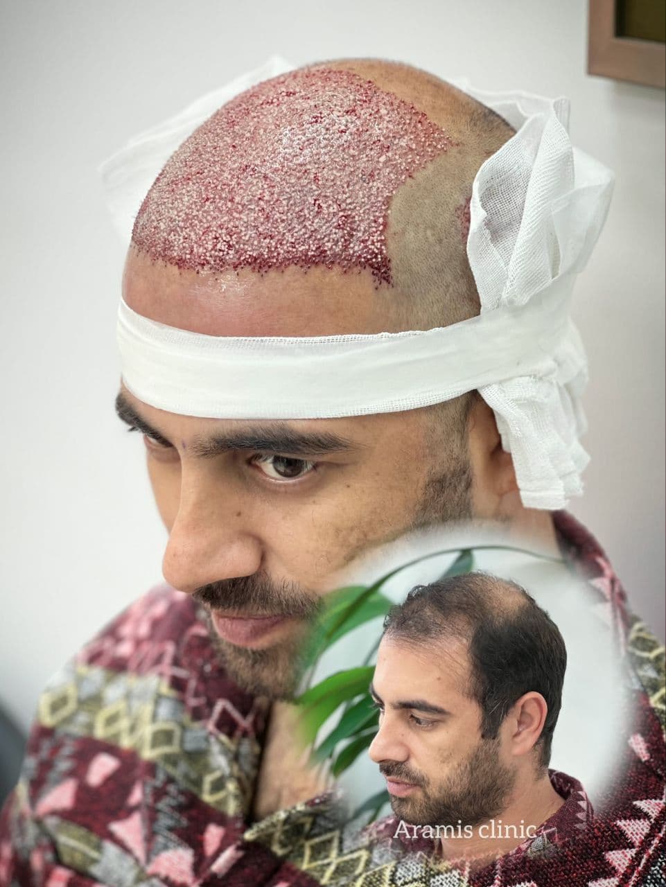 نمونه کار کاشت مو 3