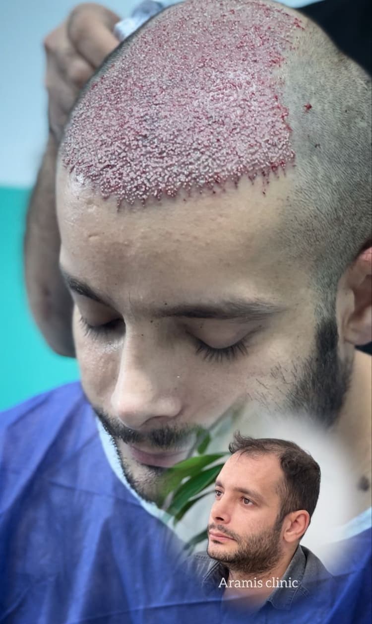 تصویر 2 - نمونه کار کاشت مو 4